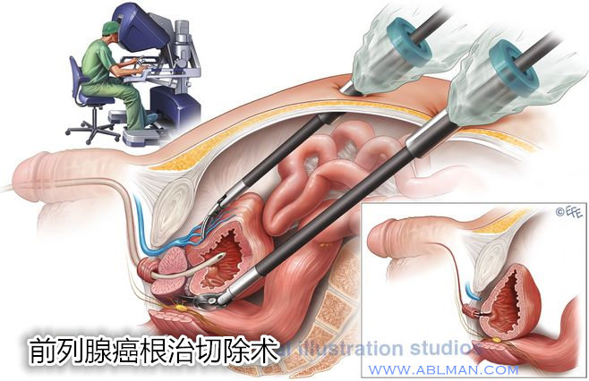 前列腺癌最新治疗进展与前景展望分析